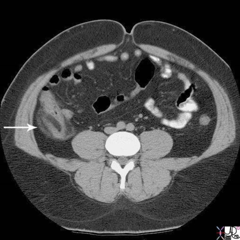 Acute Appendicitis Images | BMC Radiology